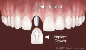 dental implant and crown replacing one tooth, dental implants Decatur, IL dentist