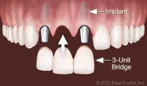 3 unit dental bridge being placed over implants to replace multiple teeth, dental implants Decatur, IL cosmetic dentistry