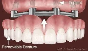 removable denture being placed over four dental implants Decatur, IL dentist