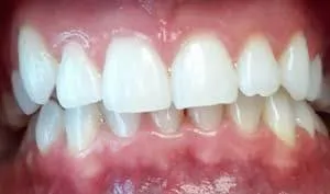 Teeth whitening After