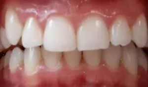 Teeth whitening Before