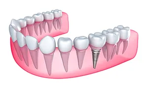 Dental Implants in Frederick, MD