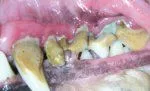 Periodontal_Disease_Stage_4.jpg