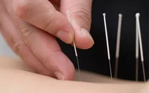 acupuncture_stock.jpg