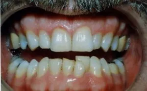 Whitening