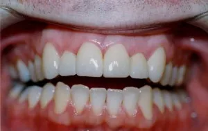 Veneers