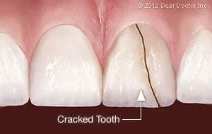 Cracked tooth.