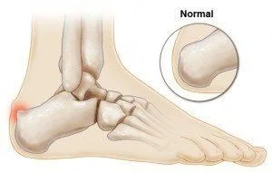 Richmond, VA Podiatrist | Richmond, VA Haglund's Deformity | VA | Preventive Foot Care |