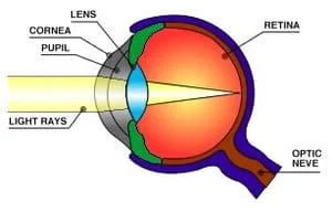 Glaucoma eye example