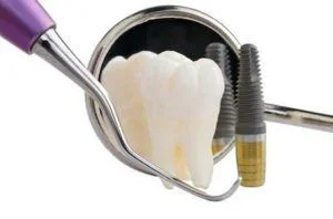Closeup of what is needed for installing dental implants at Rocky River Dentist.
