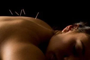 acupunture-needles-woman.jpg