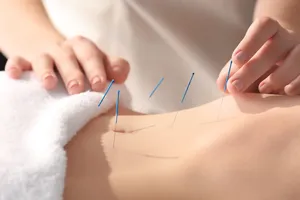 acupuncture