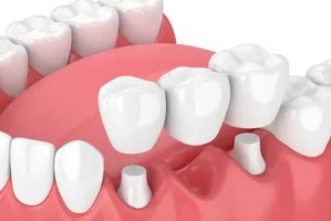 Dental Bridges Prairieville
