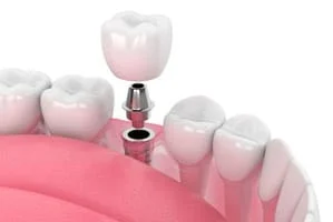 Dental Implant Restoration Prairieville