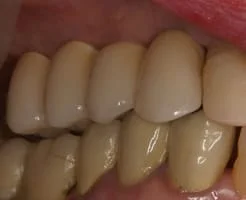 Implant Supported Bridge After