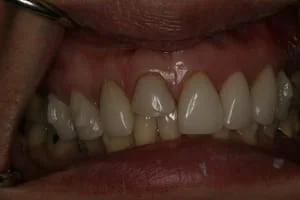 Single Crown Repairing Broken Tooth Before