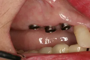 Implant Supported Bridge Before