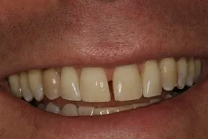 Teeth Whitening After