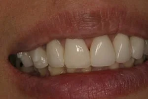 Single Crown Repairing Broken Tooth After