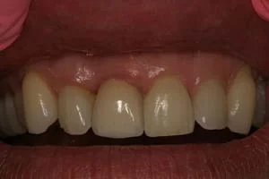 Single Tooth Implant After