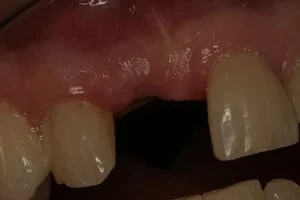 Single Tooth Implant Before
