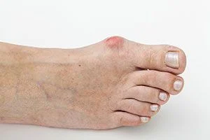 Bunions in Olney, Clinton, Kensington and Silver Spring, MD 
