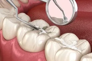 Dental Teeth Sealant