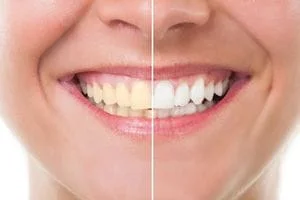 Teeth Whitening Bleaching