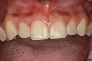 AESTHETIC CROWN LENGTHENING