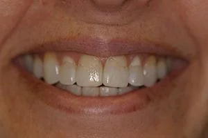 composite before, Skokie, IL restorative dentistry