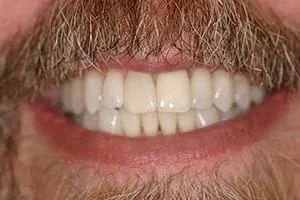 After Teeth Whitening, cosmetic dentistry Northbrook, IL