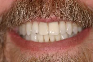 After Teeth Whitening, cosmetic dentistry Northbrook, IL