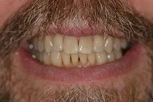 Before Teeth Whitening, cosmetic dentistry Glenview, IL