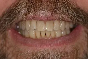 Before Teeth Whitening, cosmetic dentistry Glenview, IL