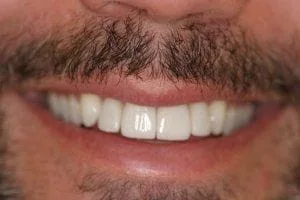 After Porcelain Veneers, cosmetic dentistry Northfield, IL