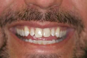 Before Porcelain Veneers, cosmetic dentistry Winnetka, IL