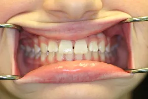 Invisalign before