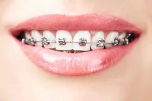 Braces on Teeth