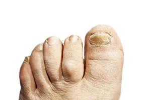 Toe deals fungus medication