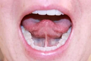 Indianapolis-laser-tongue-tie-dentist-corrections