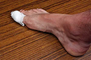 Ingrown Toenails in Chevy Chase, MD