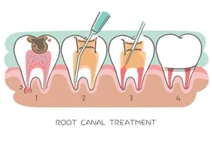 Illustration of Root Canals process, Whitby, ON