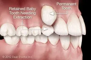 Retained baby tooth needing extraction Kinnelon, NJ