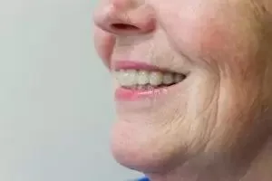 Invisalign 