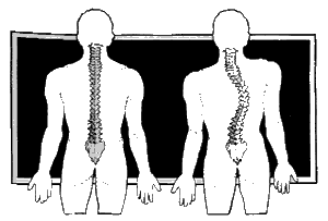 Patient with Scoliosis