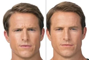 Botox for Men in Urbana Maryland, before and after Botox results