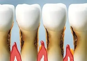 Gum Disease Treatment | Dr. Turnage | Dentist Kings Mountain