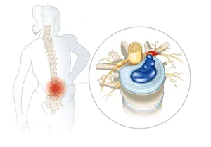 Help for Herniated Discs | Basalt, Aspen, Carbondale, Spine Spot Chiropractic