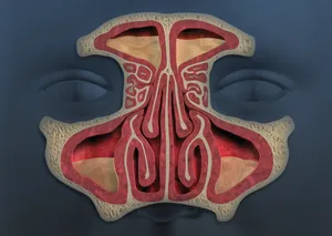 Diseased Sinuses