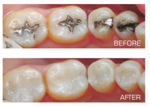 before-after-white-fillings